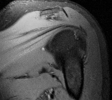 Figure 2 for case SLAP lesion with labral cyst and suprascapular nerve compression Also nearly circumferential labral tear